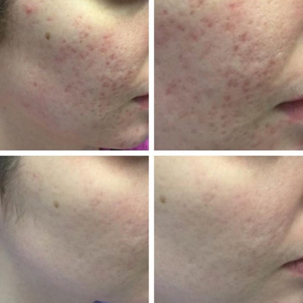 Acne Scars - Procell Microchanneling